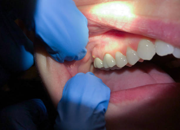 Best Emergency Dentist for Lost Fillings or Crowns in Grimes, IA